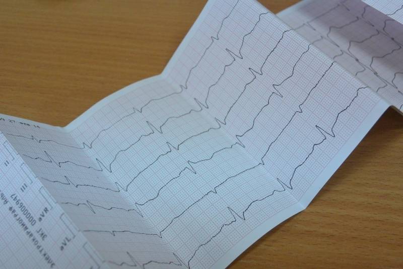 Электрокардиографическое исследование (ЭКГ) Наталья Баграновская, ИА EAOmedia
